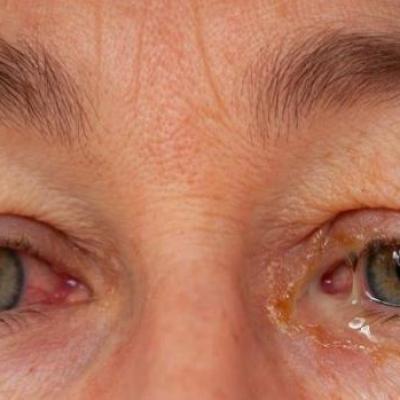 هرآنچه که باید راجع به ترشحات چشم بدانیم هرآنچه که باید راجع به ترشحات چشم بدانیم